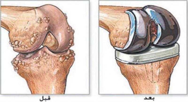 استعادة الحركة والحياة: كل ما تحتاج معرفته عن عملية تغيير مفصل الركبة!